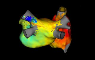 Abbott führt kardiales 3D-Mapping-System der nächsten Generation in Europa und Australien ein