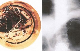 Deviceentwicklungen ohne Ende: Schrittmacher, ICDs, CRTs – Indikationen im Wandel der Zeiten
