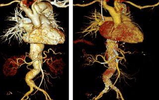 Entwicklungen in der Behandlung der Aortenerkrankungen – die Endovaskuläre Therapie