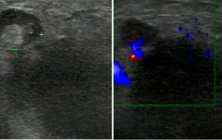 CUP – die frustrierende Suche nach Ätiologie, Diagnostik und Therapie