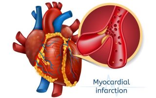 Infarktbedingter kardiogener Schock: Sofortige Revaskularisation ist entscheidend für die Prognose Infarktbedingter kardiogener Schock: Sofortige Revaskularisation ist entscheidend für die Prognose