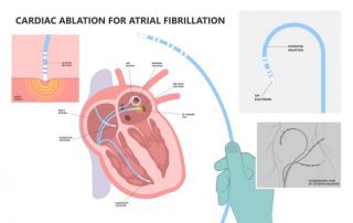 Bringt die erweiterte Ablation etwas?