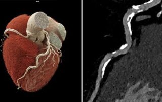 Erstmals nicht-invasive Diagnostik für Hochrisiko-Herzpatienten Erstmals nicht-invasive Diagnostik für Hochrisiko-Herzpatienten