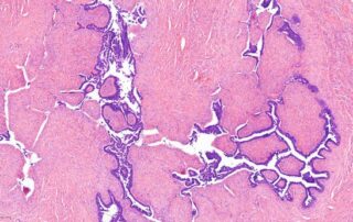 Pathologien der Mamma im juvenilen Alter Pathologien der Mamma im juvenilen Alter
