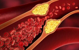 Atherosklerose: RNA-Schnipsel eröffnet Perspektive für neue Therapien Atherosklerose: RNA-Schnipsel eröffnet Perspektive für neue Therapien