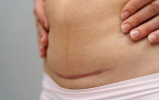 Starke Schmerzen nach Kaiserschnitt – Neue Studie fordert bessere Versorgung Starke Schmerzen nach Kaiserschnitt – Neue Studie fordert bessere Versorgung