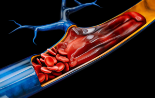 Phase-II-Studie mit erstem Anti-alpha2-Antiplasmin-Antikörper bei tiefer Venenthrombose gestartet Phase-II-Studie mit erstem Anti-alpha2-Antiplasmin-Antikörper bei tiefer Venenthrombose gestartet