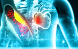 Bempedoinsäure: Mit LDL-C-Senkung kardiovaskuläre Ereignisse reduzieren Bempedoinsäure: Mit LDL-C-Senkung kardiovaskuläre Ereignisse reduzieren