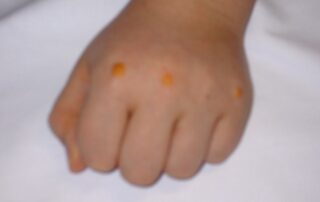 5-jähriges Kind mit heterozygoter Familiärer Hypercholesterinämie.